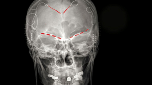 Los científicos encuentran nuevas pistas en el cerebro para tratar el dolor crónico