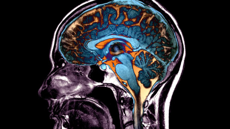 Cinco formas en que el cerebro puede envejecer